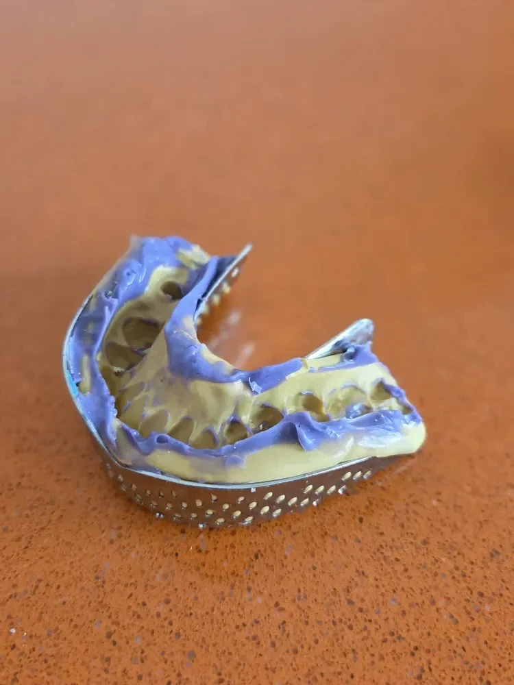 Dentalni otisak donje vilice u metalnoj kašici, priprema za protetiku u Bonkolinusu
